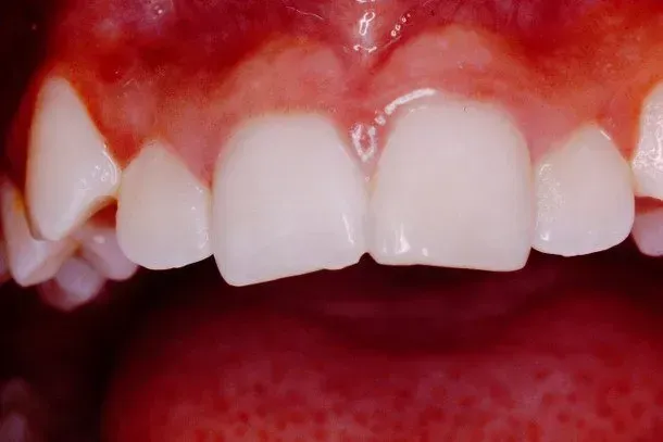 A close up of a person 's teeth with a missing tooth.