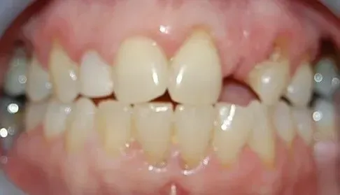 A close up of a person 's teeth with a hole in the middle.