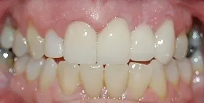 A close up of a person 's teeth with white teeth.