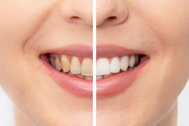 Side-by-side smile showing teeth cleaning transformation from yellow to white.
