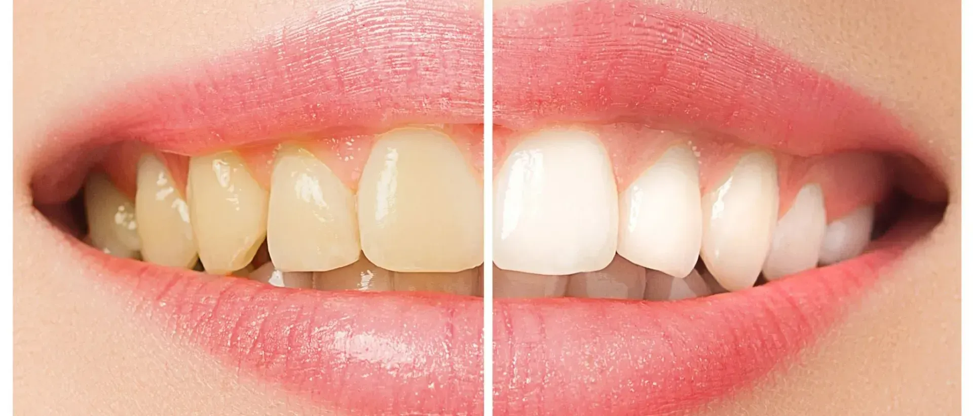 A close up of a woman 's teeth before and after whitening.