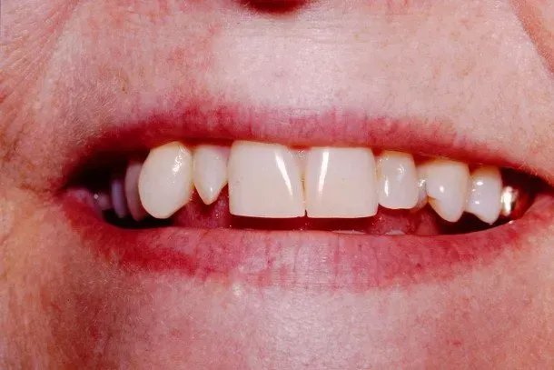 A close up of a woman 's mouth with a missing tooth.