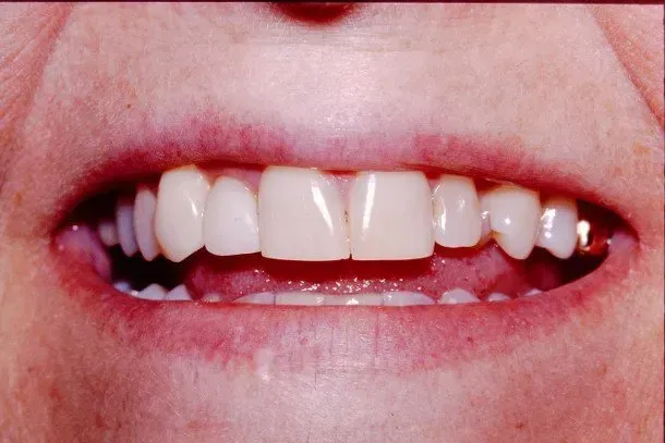 A close up of a person 's mouth with white teeth