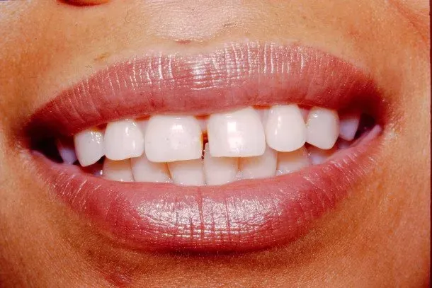 A close up of a woman 's mouth with white teeth and pink lips.