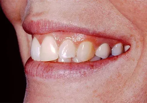 A close up of a woman 's mouth with white teeth.