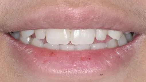 A close up of a person 's mouth with white teeth.