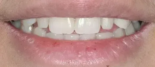 A close up of a person 's mouth with white teeth.