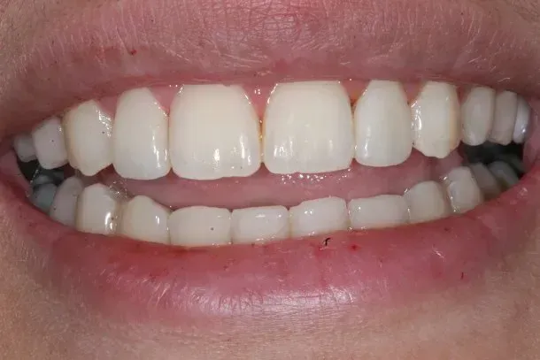 A close up of a person 's teeth with white teeth.