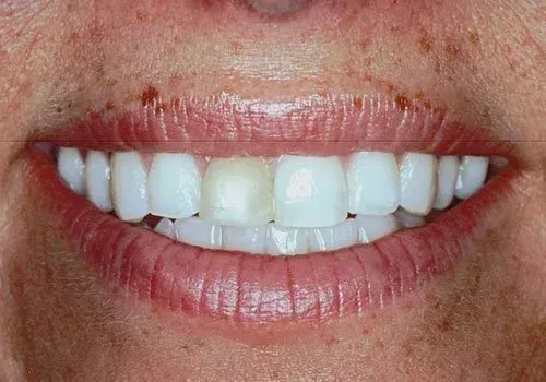 A close up of a woman 's mouth with white teeth.