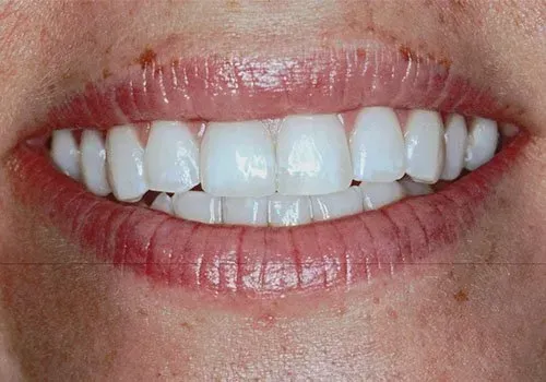 A close up of a woman 's mouth with white teeth.