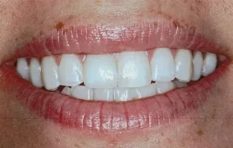 A close up of a woman 's mouth with white teeth.