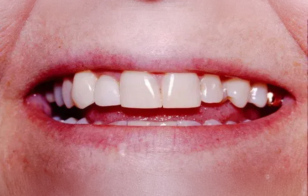 A close up of a person 's mouth with white teeth