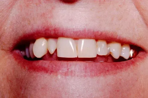 A close up of a woman 's mouth with a missing tooth.
