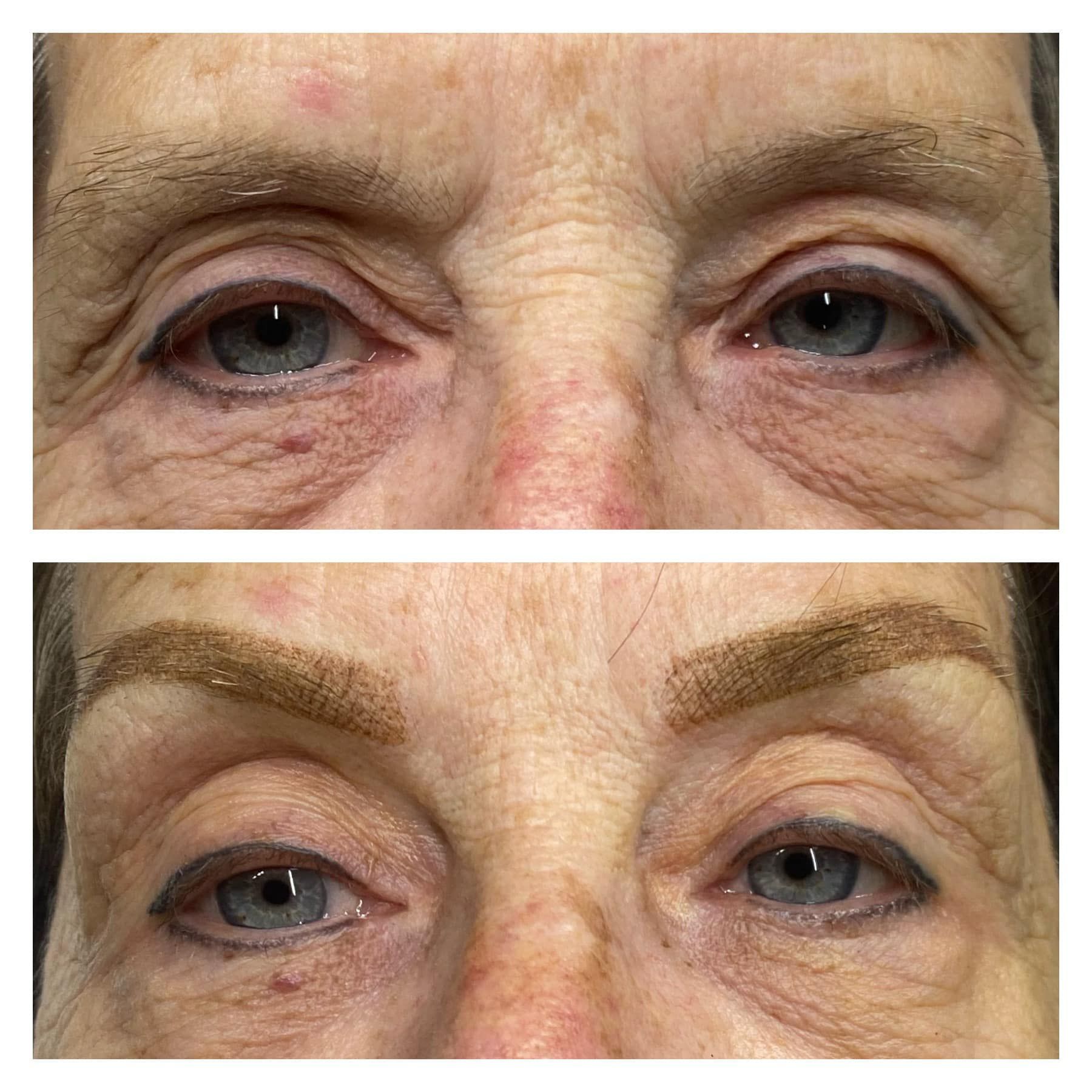 Before and after photos of a woman's eyes. Upper photo: drooping eyelids and sparse eyebrows.