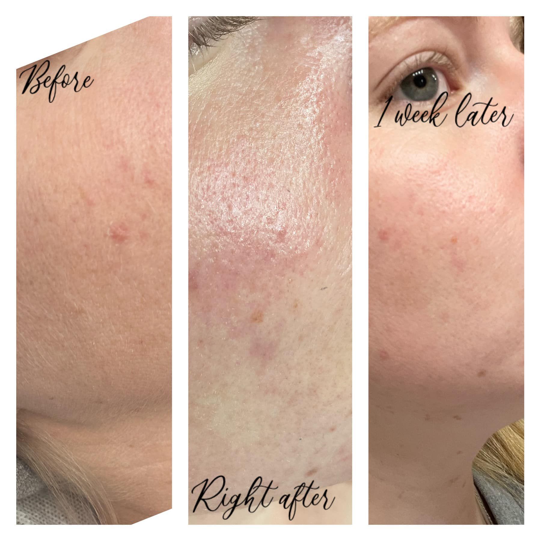 Sequence of a person's face: Before, right after a treatment, and one week later, showing skin improvements.