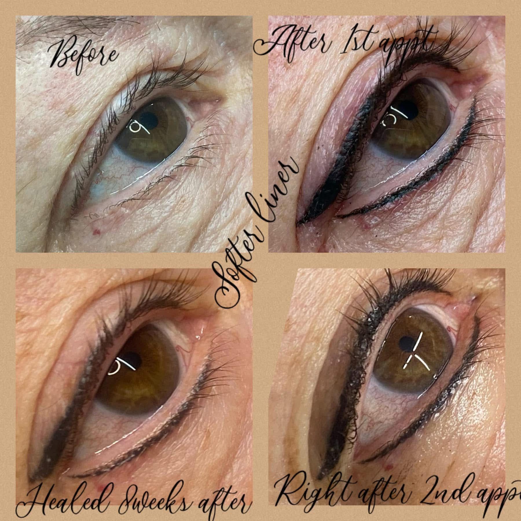 Eye with eyeliner transformation: before, after 1st application, healed, and right after 2nd application.