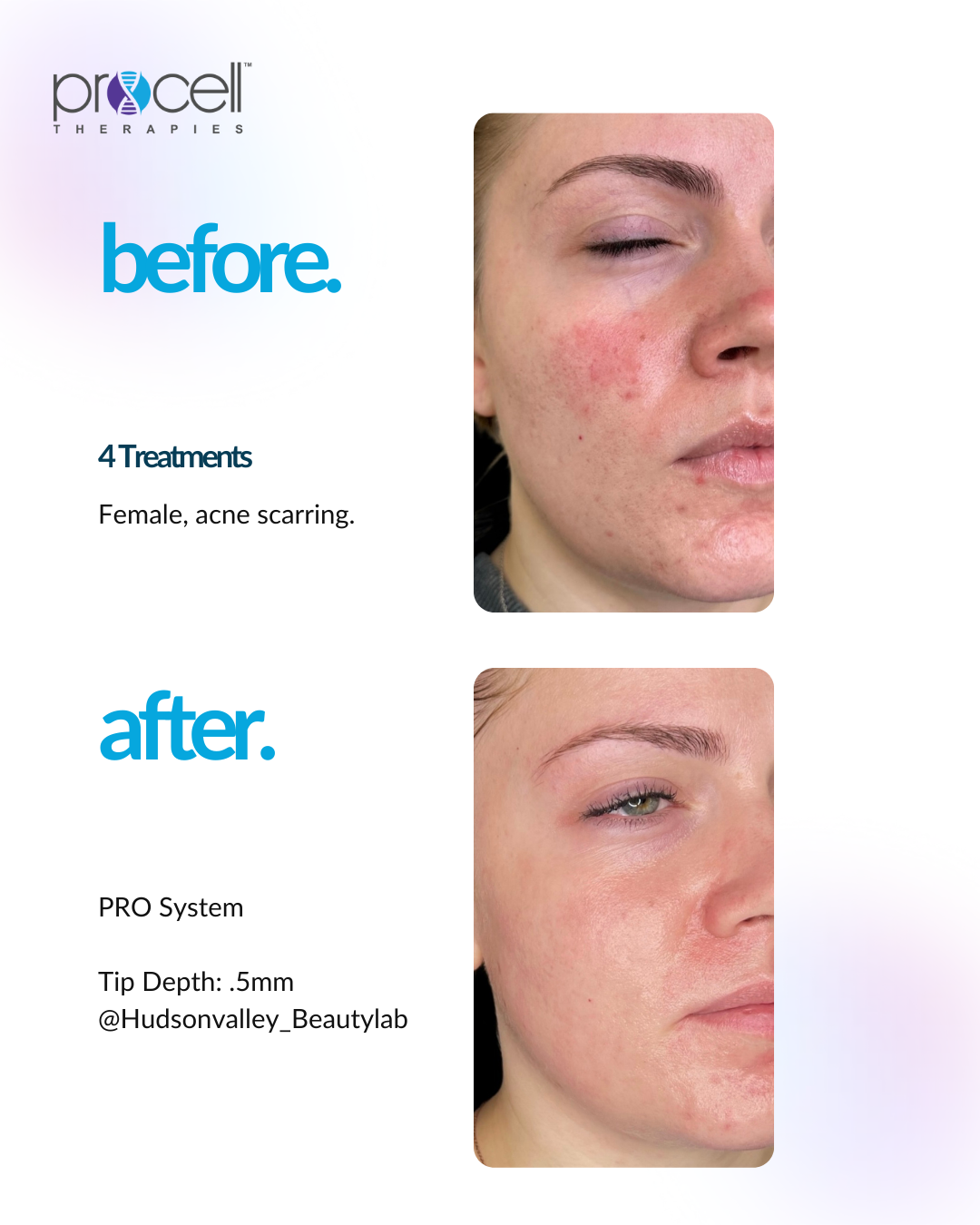 Comparison: facial acne before and after 4 treatments. Improved skin, less redness after.