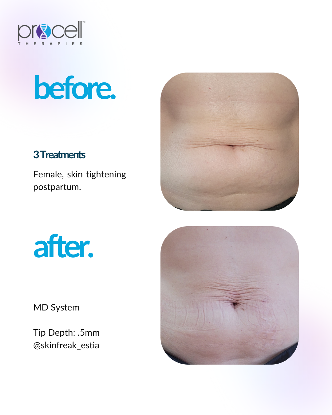 Before-and-after photos of a woman's stomach after skin tightening treatments.