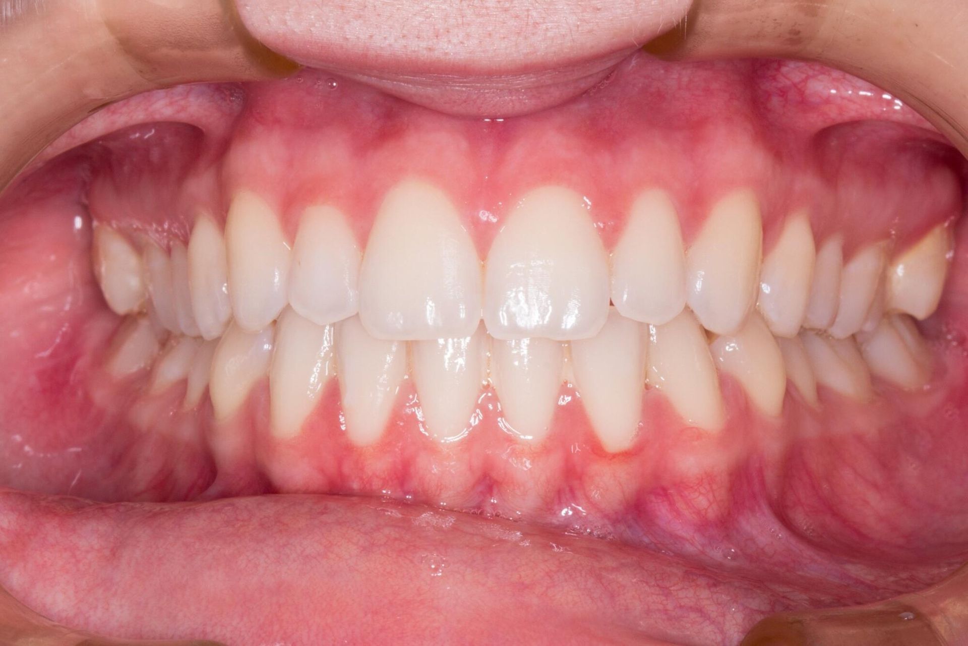 A close up of a person 's mouth with white teeth.
