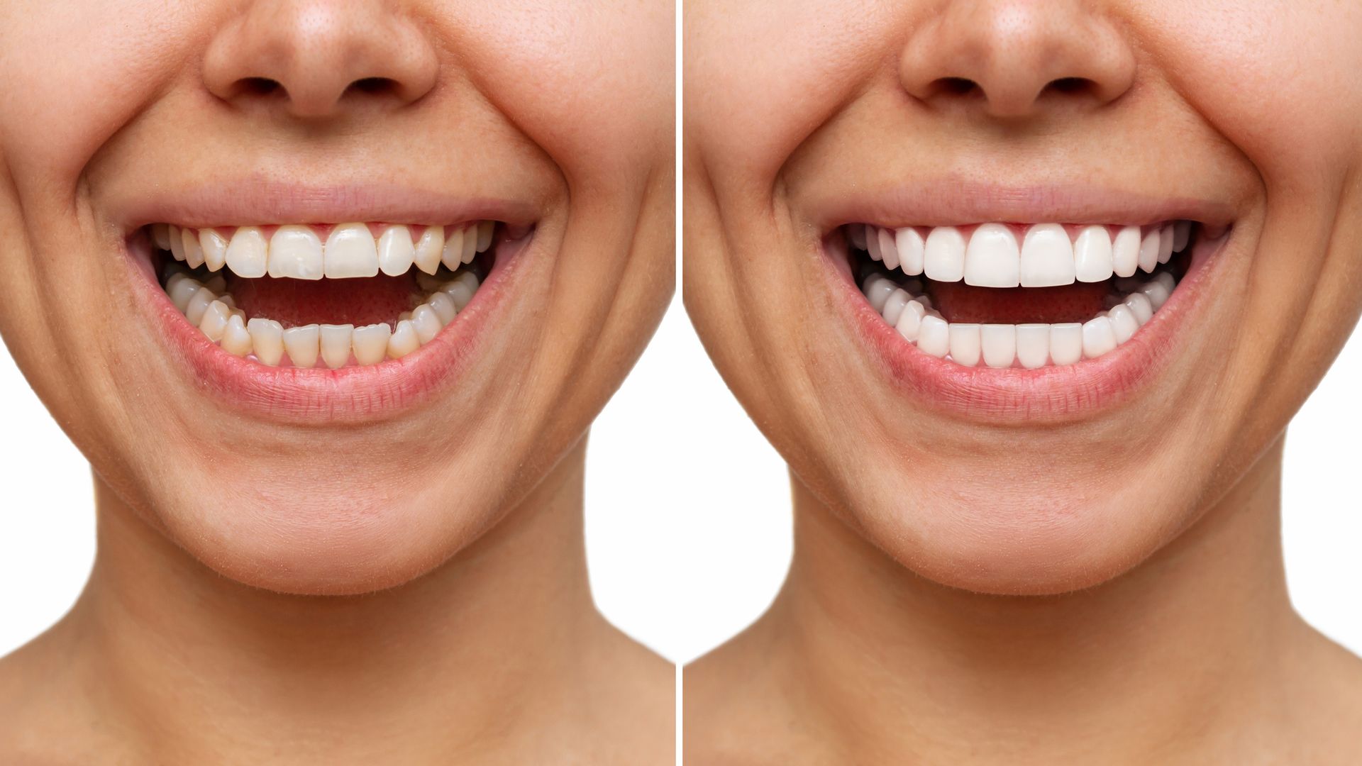 A before and after picture of a woman 's smile.
