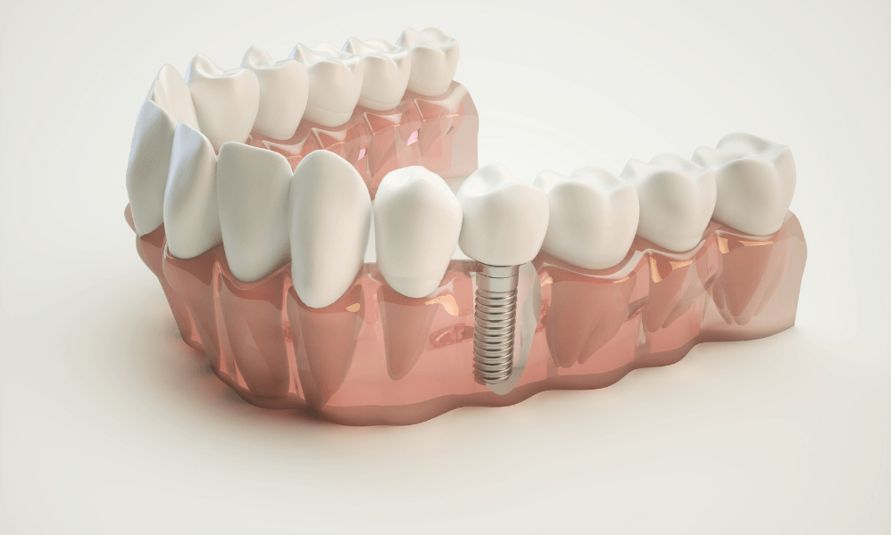 Dental Implants in Corona, CA