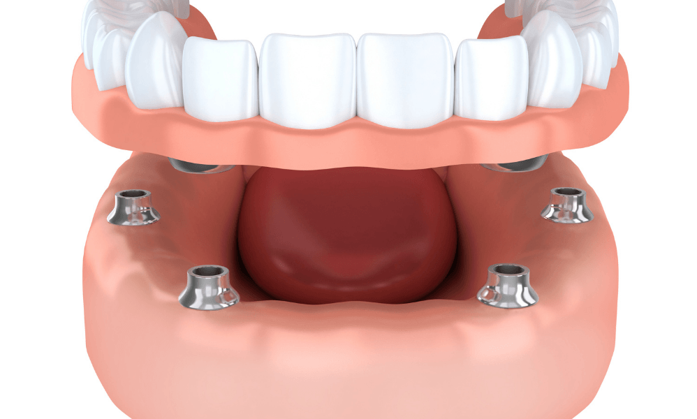 Implant-Supported Dentures in Corona, CA