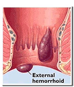 Illustration of an anus with two external hemorrhoids: a large dark one and a smaller one.