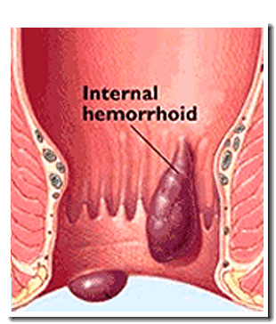 Diagram of an anus with two internal hemorrhoids depicted as dark, swollen bulges.
