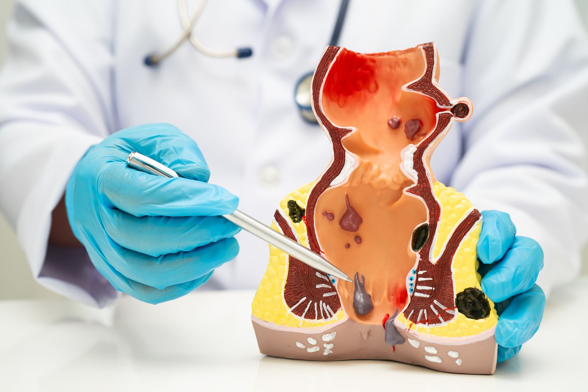 A doctor in blue gloves uses a pointer to explain an anatomical hemorrhoid model.