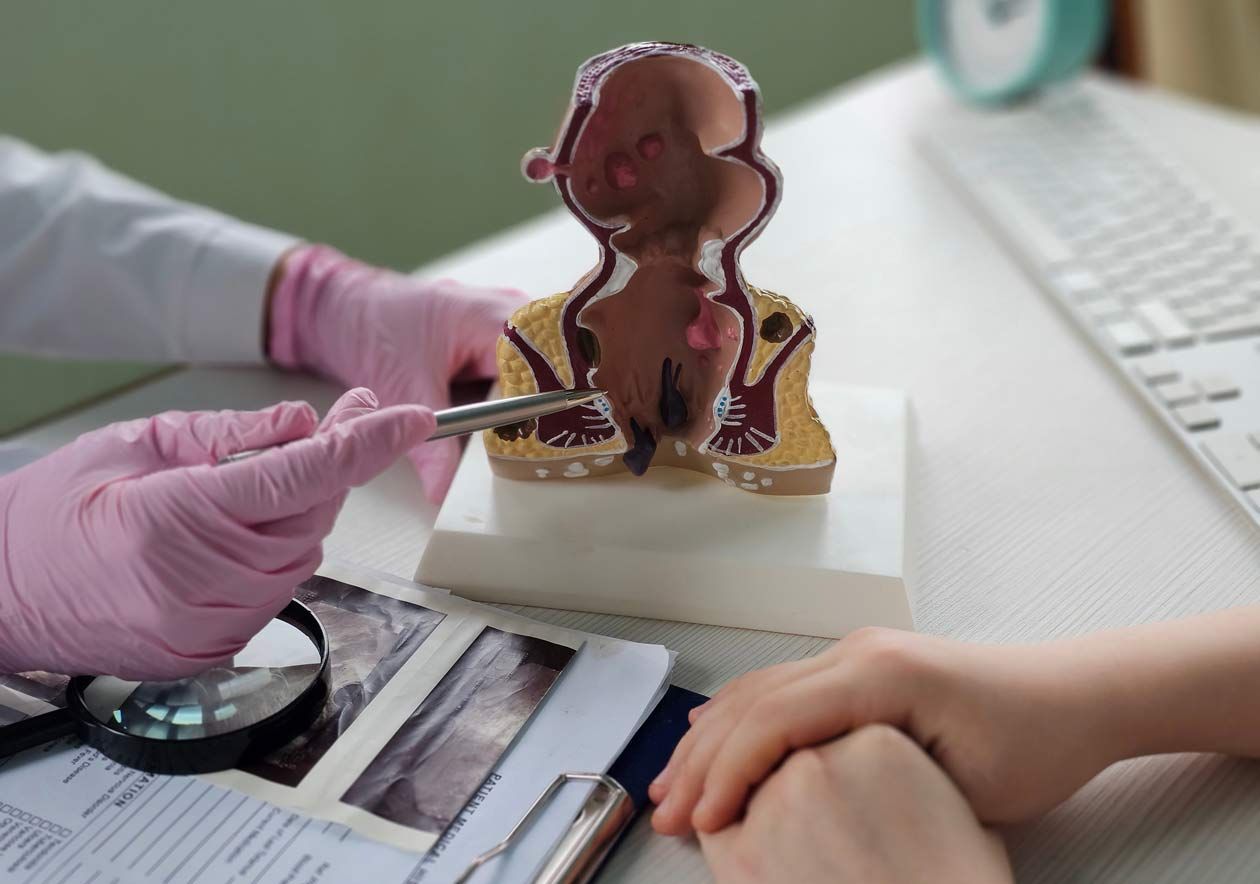 Patient and doctor review rectum anatomy model with hemorrhoids in hospital.