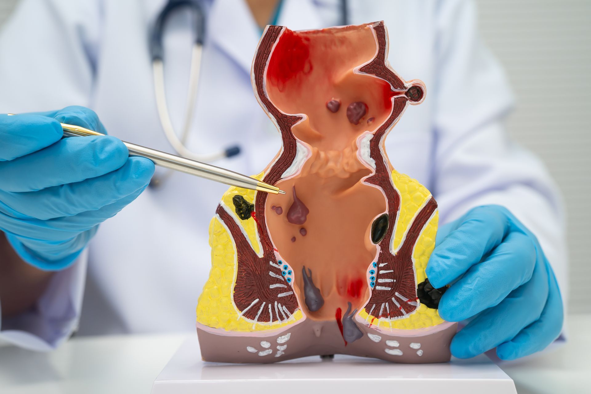 A doctor is explaining a model of a rectum and anus anatomy. A doctor is explaining a model of a rectum and anus anatomy.