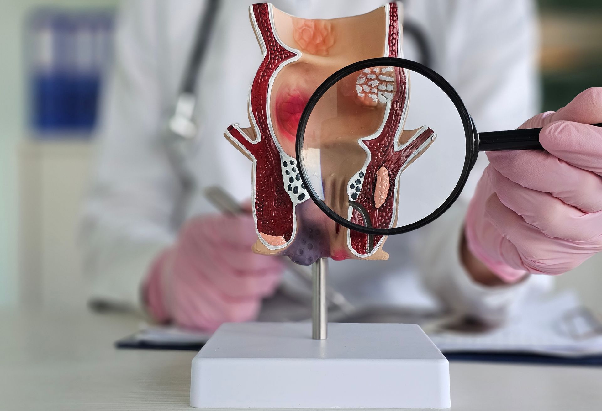 The proctologist holds a magnifying glass and a rectal model showing hemorrhoids with labeled signs. The proctologist holds a magnifying glass and a rectal model showing hemorrhoids with labeled signs.