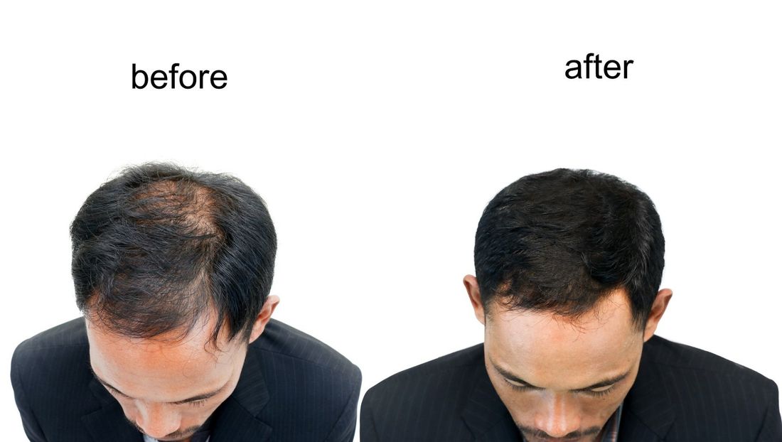 Impianto di capelli prima e dopo