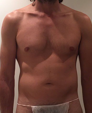 Best liposuction abdomen definition natural tasmania liposuction melbourne lipo waist liposculpture body contouring 360 cosmetic plastic surgeon before after