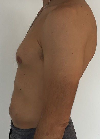 best top liposuction liposculpture waist back bbl brazillian lipo waist how much lipo tasmania melbourne smooth shape waist
