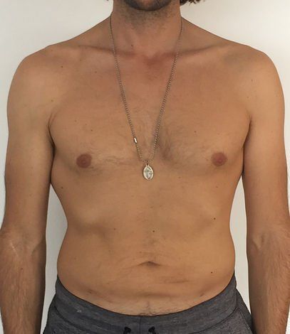 thighs arms tummy waist tasmania liposuction melbourne lipo waist liposculpture body contouring 360 cosmetic plastic surgeon