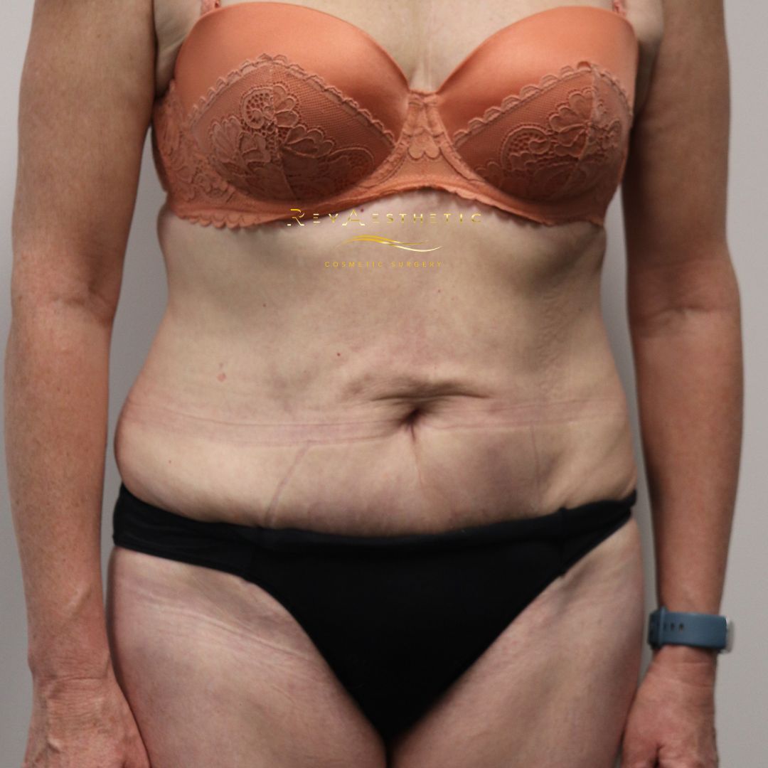 best  top tasmania cosmetic surgeon tummy tuck remove skin lift tissues flat look before after results