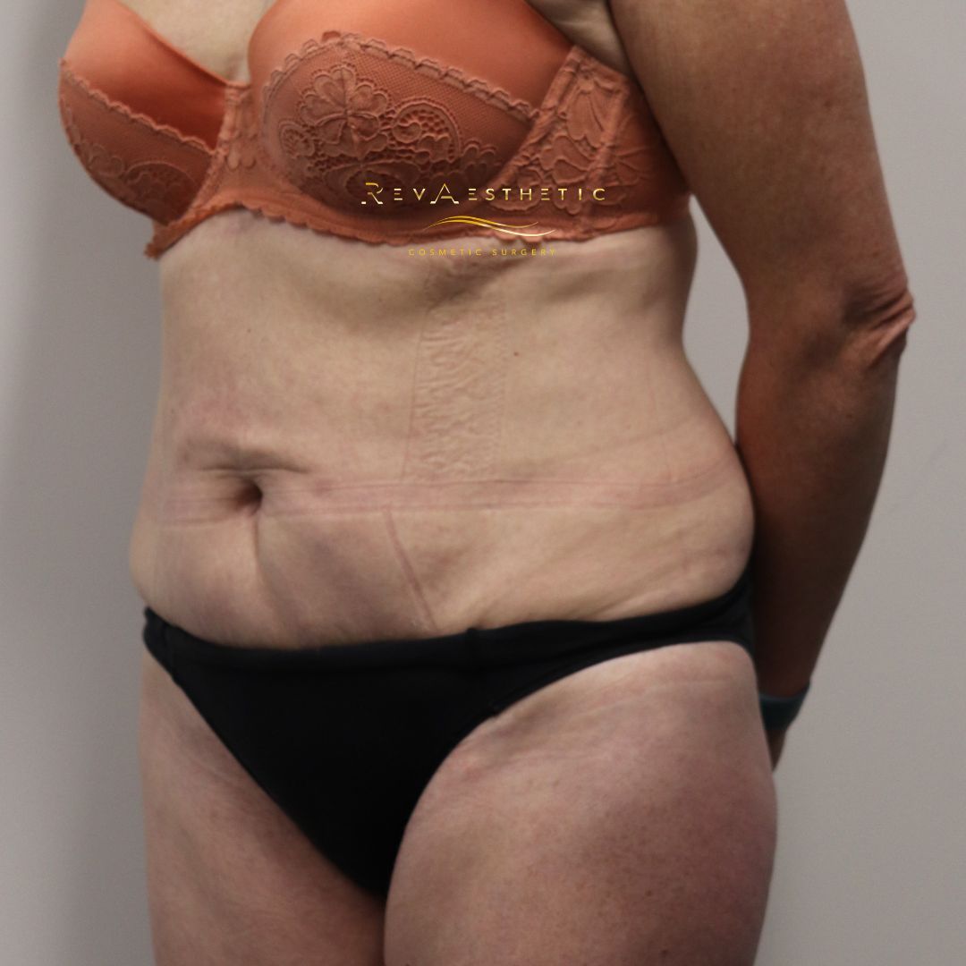 best  top tasmania cosmetic surgeon tummy tuck remove skin lift tissues flat look before after results