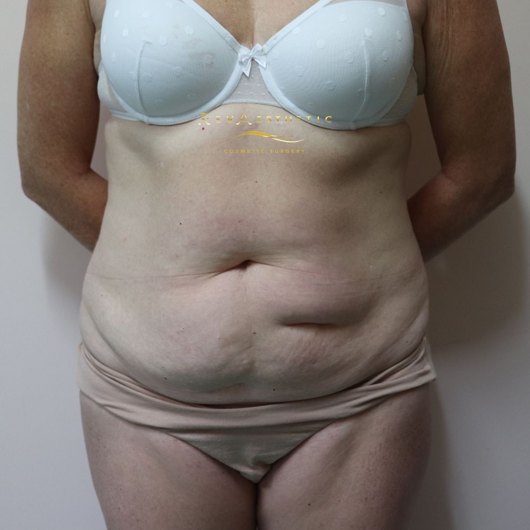 saggy tummy  alot of skin surgery cosmetic