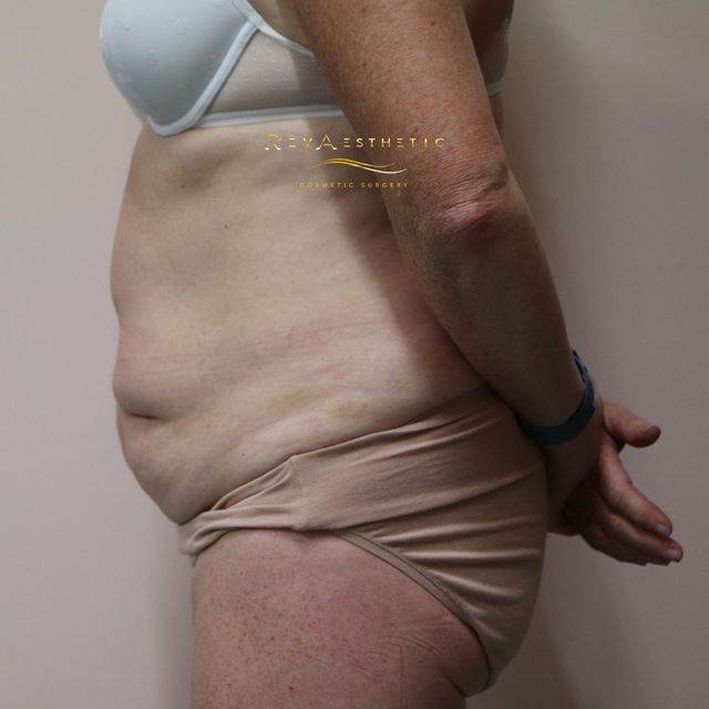 Tummy Tuck Surgery (Abdominoplasty) - Sydney Cosmetic Clinic