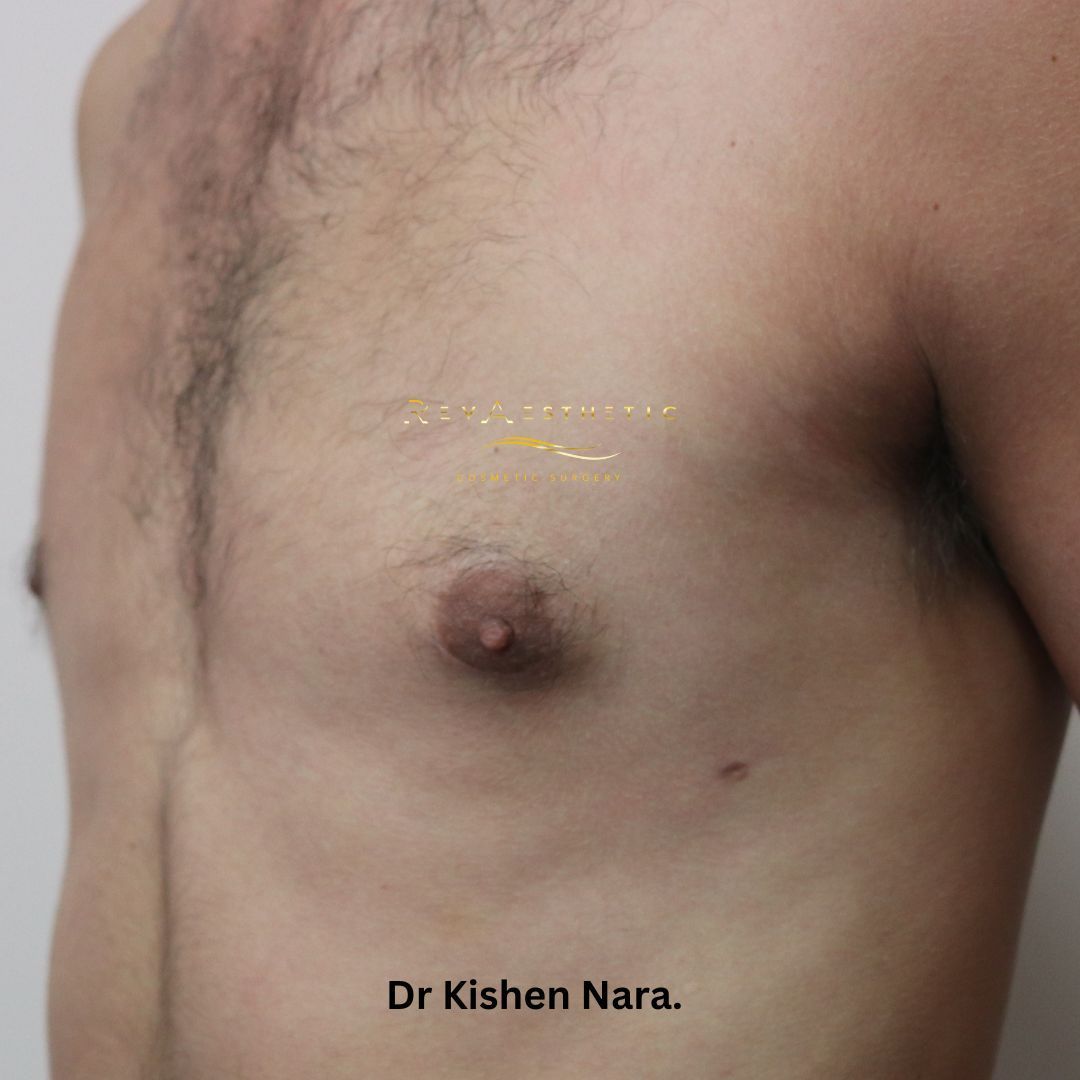 Gynaecomastia surgery, manboob surgery correction, top man chest enhancement gynaecomastia surgery, small cut or incision, liposuction manboobs, man boob melbourne tasmania