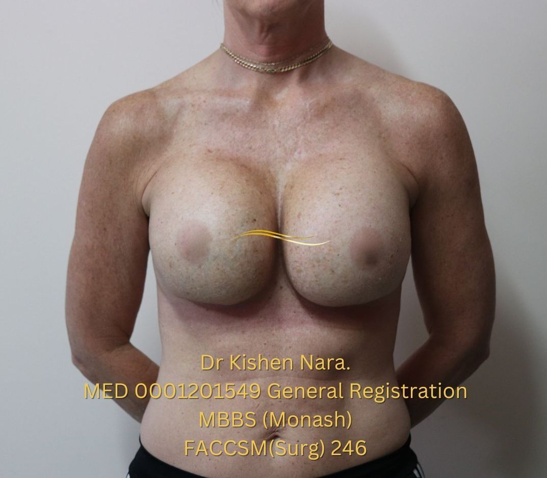 Top cosmetic surgeon breast implants Melbourne Tasmania before after gallery
