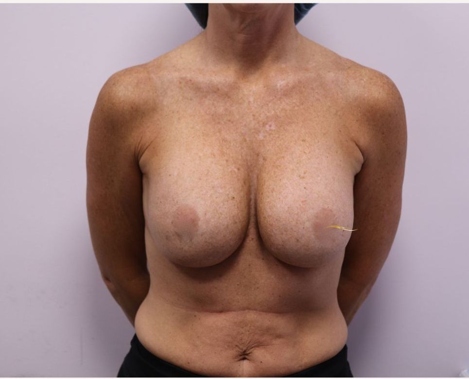 Best cosmetic surgeon revision removal replace breast implants melbourne tasmania