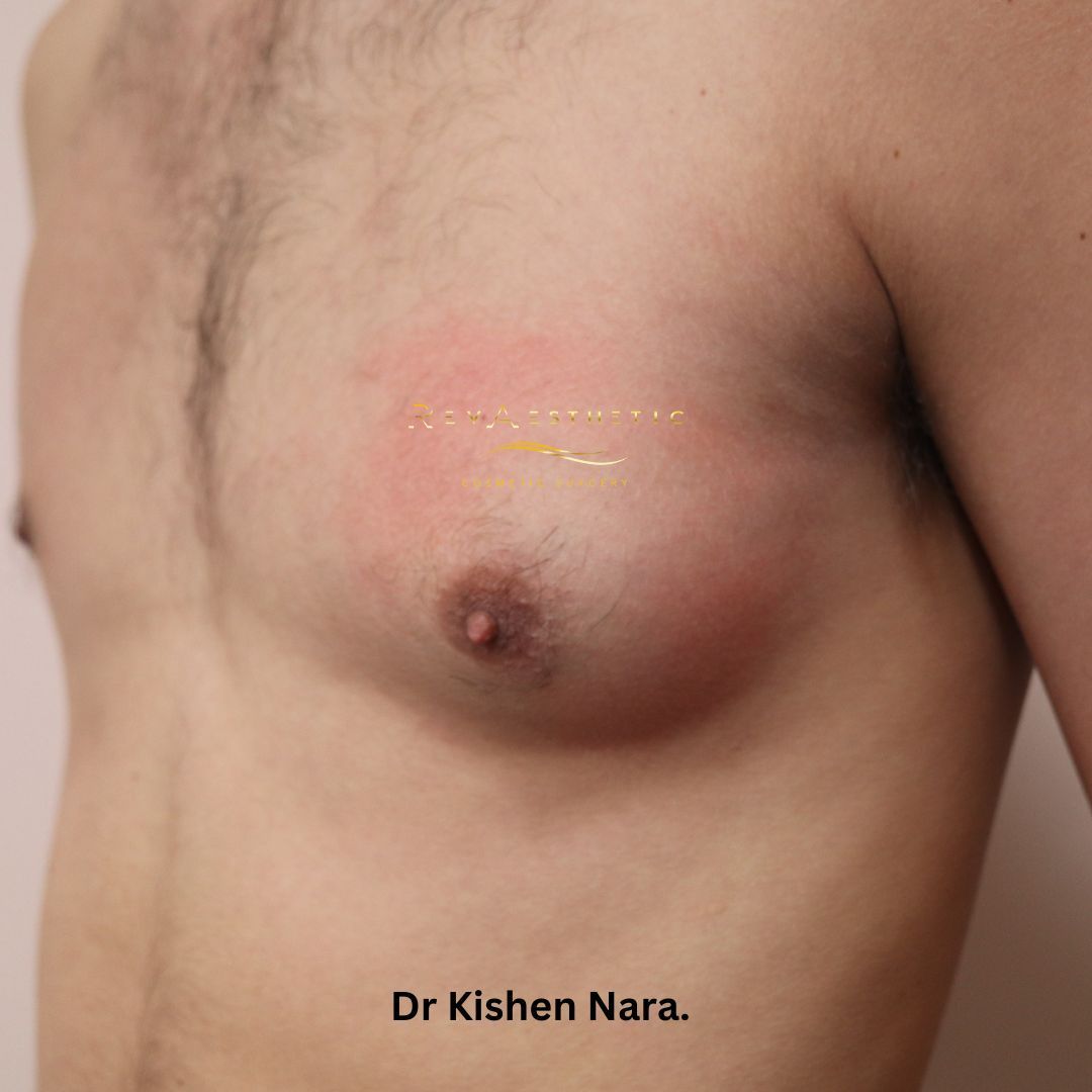 Manboob gynaecomastia fat in breast men top cosmetic surgery liposuction surgery melbourne tasmania