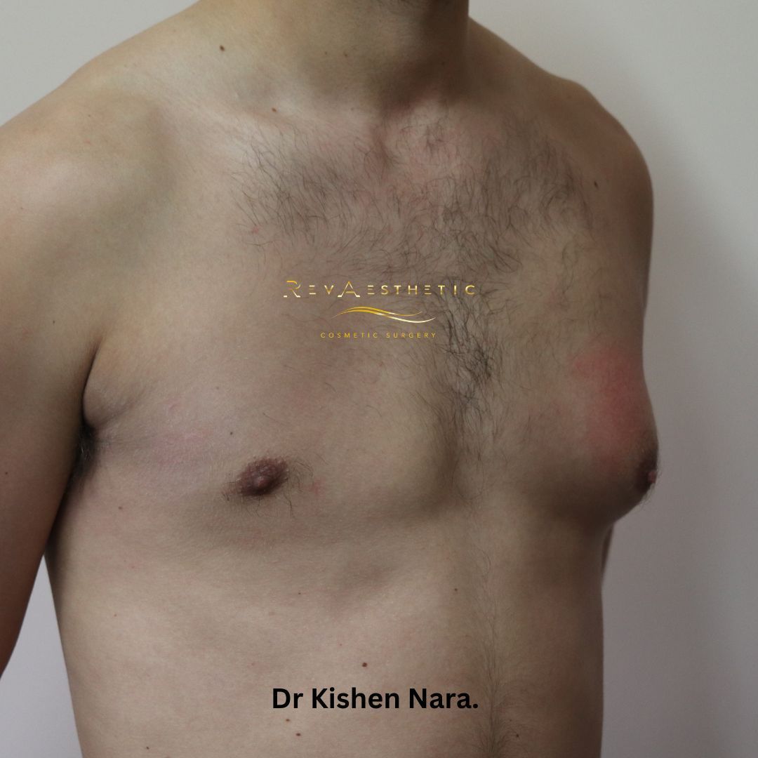 Gynaecomastia manboob one side top best liposuction surgery melbourne tasmania