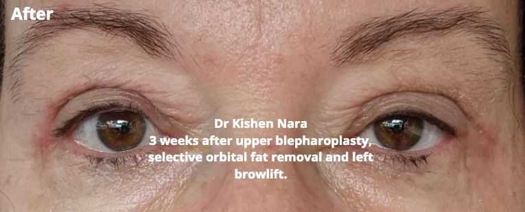 best cosmetic upper eyelid lift surgery and browlift surgery melbourne ,malvern east, devonport, armdale and elwood.