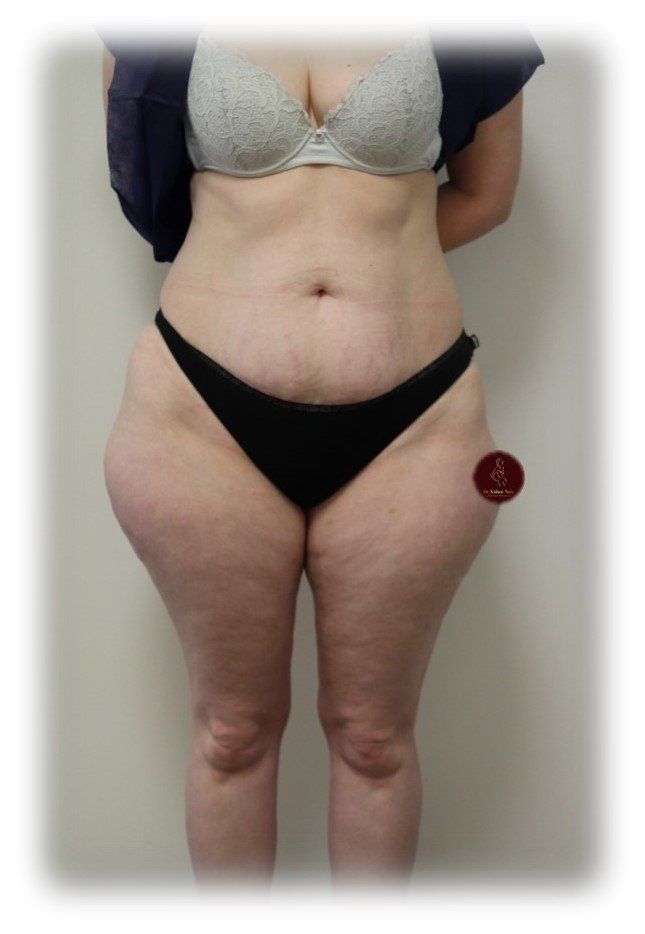 Top before after liposuction hips liposculpture contour shape lipo tasmania melbourne tas sculpt
