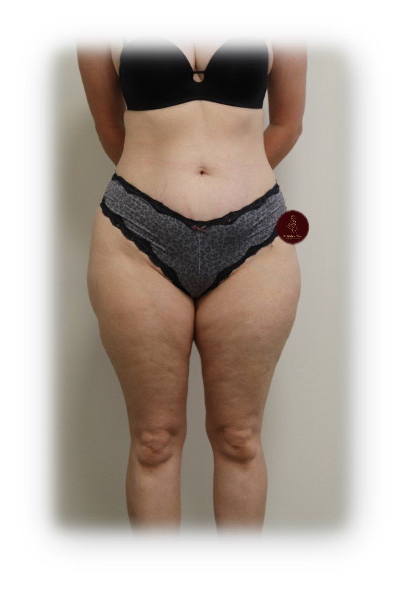 BEST before after liposuction large outer hips hip dips lipo waist tasmania melbourne liposculpture sculpt cosmetic surgeon