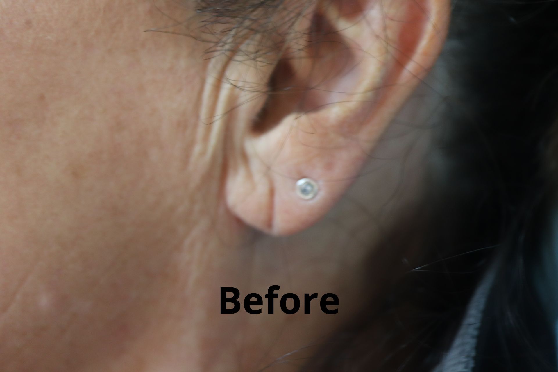 best top before after ear lobe repair melbourne tasmania cosmetic surgery