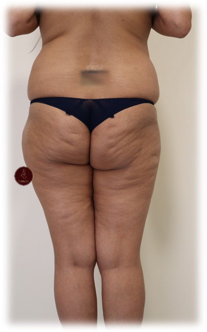 best thigh liposuction tasmania top legs thighs melbourne liposculpture 360 lipo